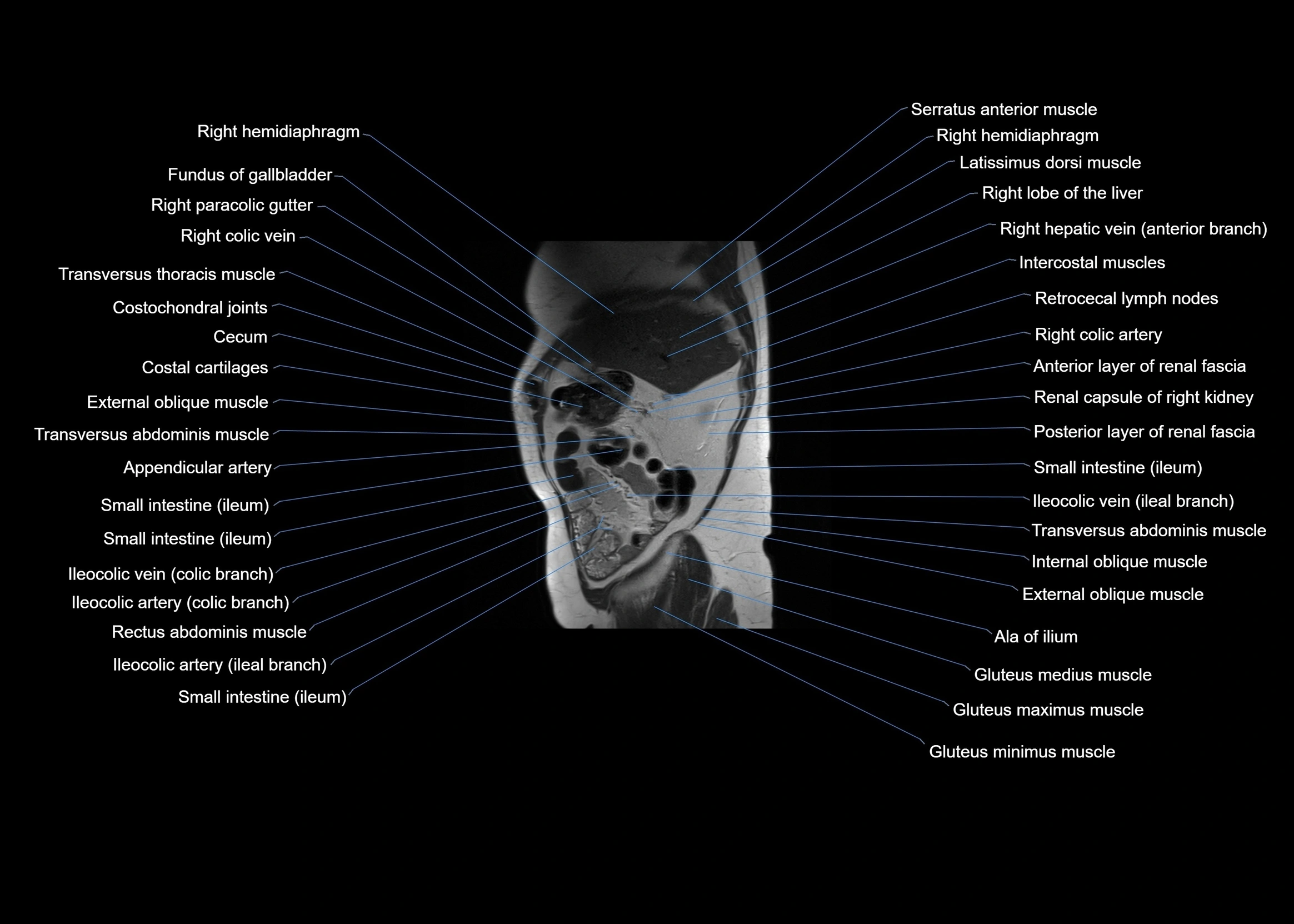 MRI abdomen sagittal cross sectional anatomy  radiology  image-img-00001-00015.webp